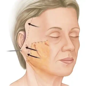 Ritidoplastia colombia