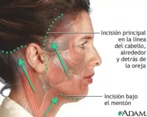 lifting facial colombia